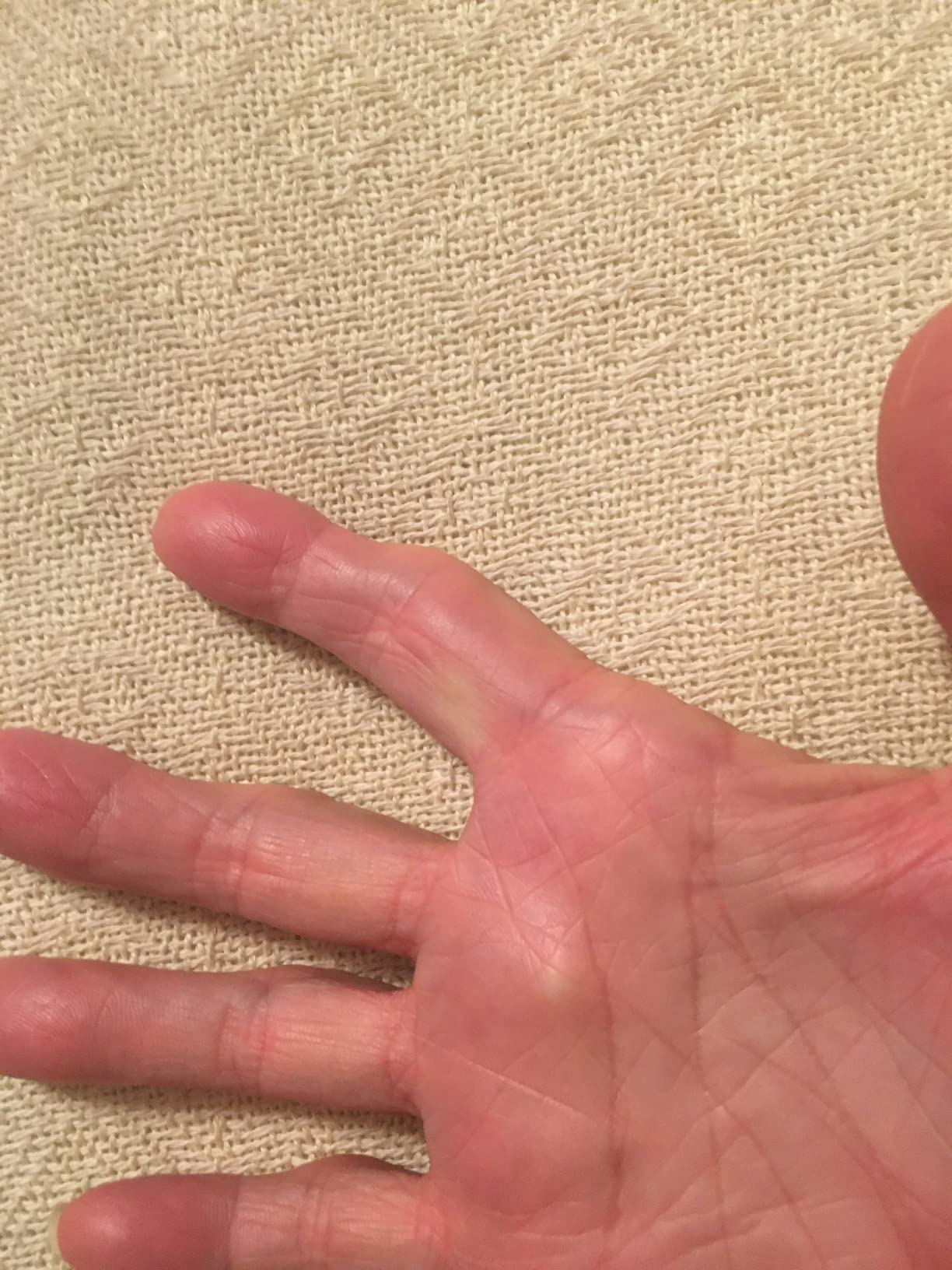 HANDFIX-The One and Only Patented Finger Brace for Trigger Fingers-Anatomically Positions the Finger to Optimize Healing-One Size fits most Right or Left-Quality Made by a Licensed Occupational Therapist/Certified Hand Therapist- HSA/FSA Approved customer photo 2