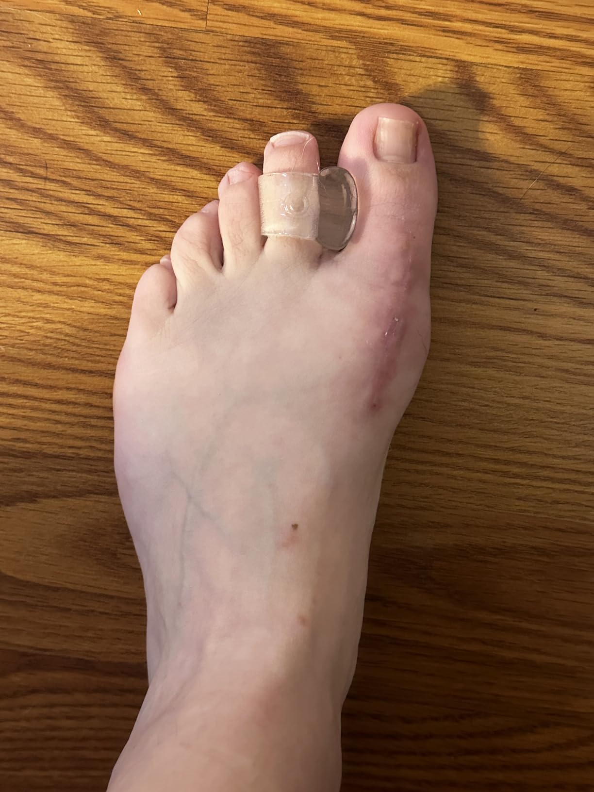 ZenToes Gel Toe Separators for Overlapping Toes, Bunions, Big Toe Alignment, Corrector and Spacer - 4 Pack (White) customer photo 1
